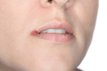 Naklejka premium Herpes simplex auf der Oberlippe einer jungen Frau