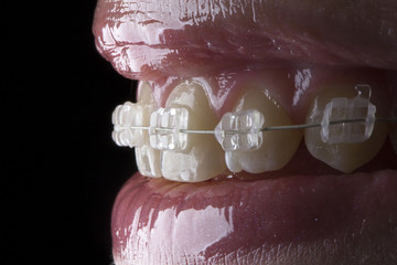clear braces