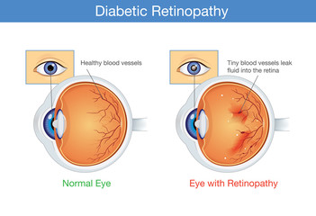 Anatomy of normal eye and Diabetic retinopathy in people who have diabetes. Illustration about health and eyesight. - obrazy, fototapety, plakaty