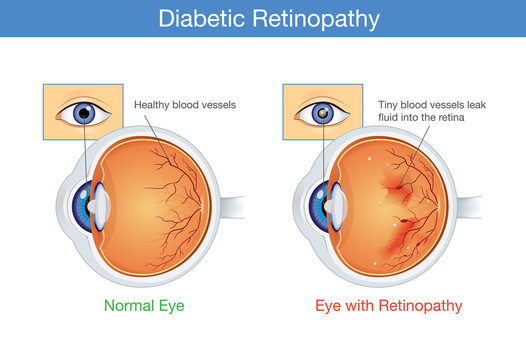 Anatomy Of Normal Eye And Diabetic Retinopathy In People Who Have Diabetes. Illustration About Health And Eyesight.