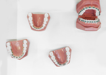 Set of jaw models with dental bracket on white background