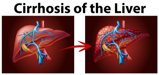 Diagram showing cirrhosis of the liver
