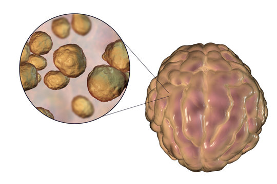 Meningitis infection caused by fungi Cryptococcus neoformans, 3D illustrstion