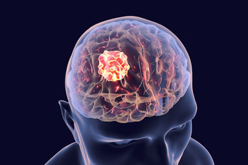 Brain cancer, 3D illustration showing presence of tumor inside brain