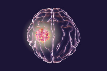 Destruction of brain tumor, 3D illustration. Conceptual image for brain cancer treatment