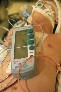 MONITORING A PACEMAKER
