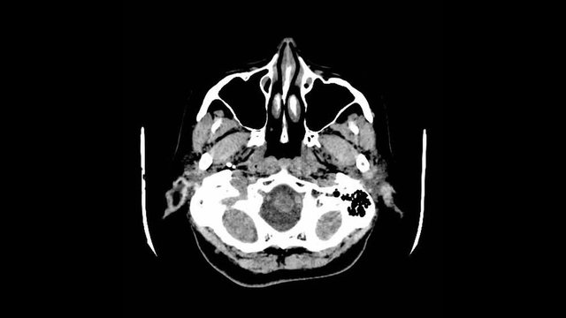 Computed tomography of the neck and skull.