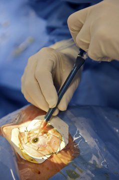 CATARACT, SURGERY