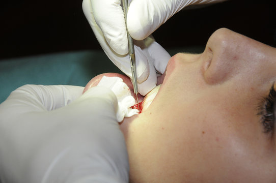 GINGIVAL GRAFT