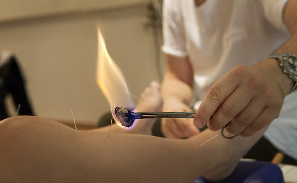 ACUPUNCTURE