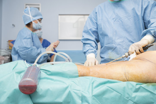 LIPOFILLING