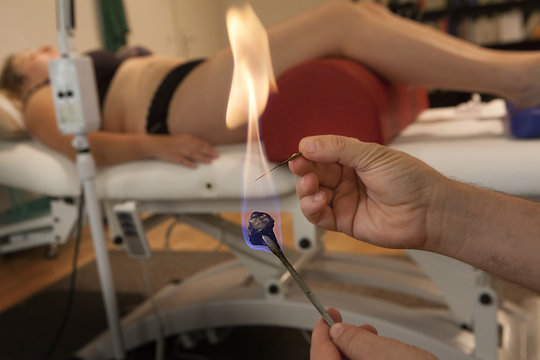 ACUPUNCTURE