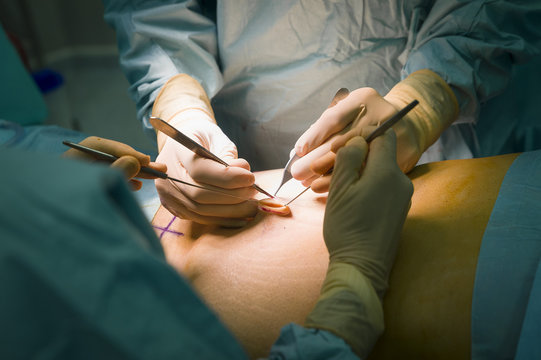 ABDOMINOPLASTY