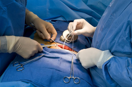 IMPLANTABLE INSULINE POMPE