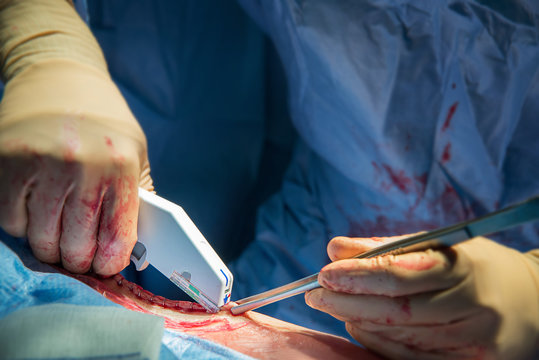 HIP PROSTHESIS, SURGERY