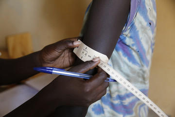 Refugee camp. malnutrition prevention program run by concern worldwide.