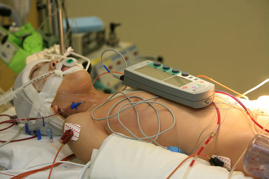 MONITORING A PACEMAKER