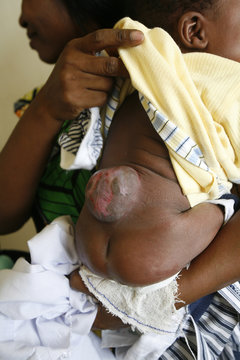 SPINA BIFIDA