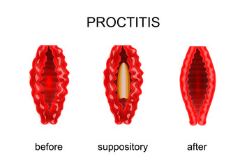 proctitis. before and after treatment of rectal suppositories
