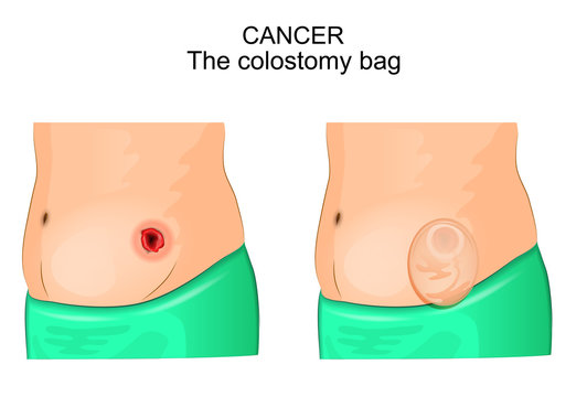 a colostomy bag after operation of colostomy