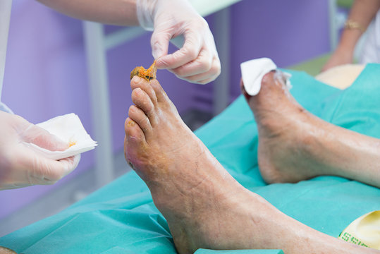 DIABETIC FOOT