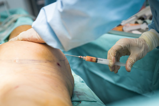 LIPOFILLING