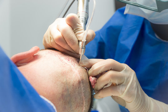 HAIR TRANSPLANTATION