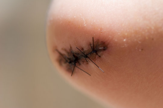 SURGERY, SUTURE