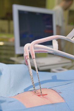 KIDNEY TUMOR, CRYOTHERAPY