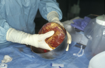 HEART TRANSPLANT
