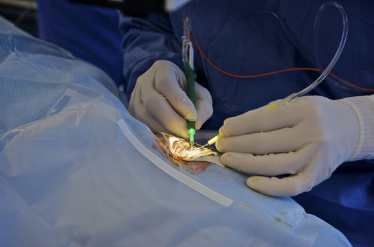 CATARACT, SURGERY