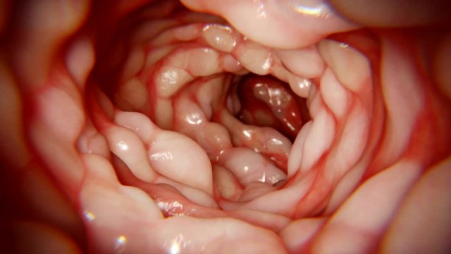 Crohn's disease intestine, animation