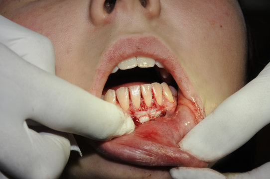 GINGIVAL GRAFT