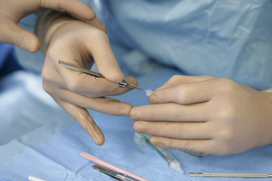 CATARACT, SURGERY