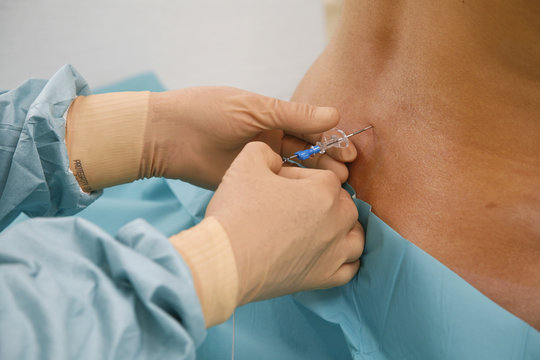 EPIDURAL ANESTHESIA