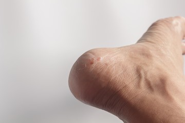 Foot fungus on a white background