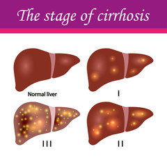 cirrhosis of the liver stages