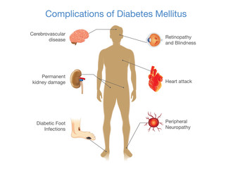 Complications of Diabetes Mellitus in people. Illustration in Infographic style about medical and health. - obrazy, fototapety, plakaty