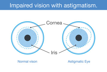 The different between normal vision and Impaired vision with astigmatism in front view. Illustration about common eye problem.