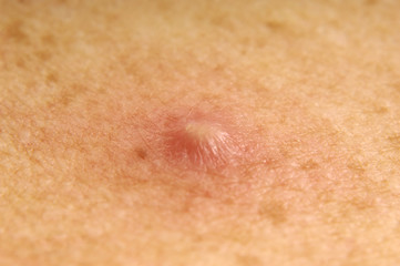 Fototapeta premium blemish of pus