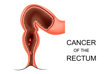 cancer of the rectum - obrazy, fototapety, plakaty