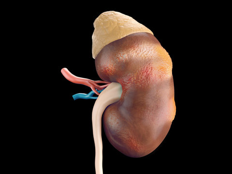 Human kidney cancer