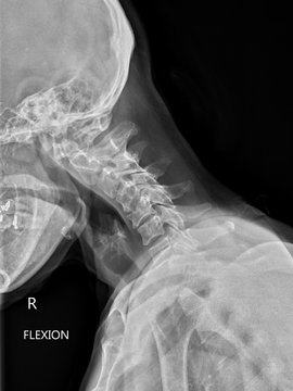 x-ray of cervical spine or neck in flexed position
