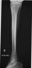 X-ray of human leg lateral view