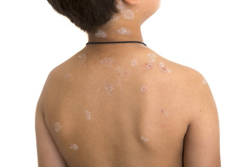 kid; back; chickenpox; sick; measles; child; virus; varicella; illness; health; skin; disease; ill; infection; pox; rash; red; childhood; pain; scratch; patient; reaction; boy; contagious; closeup; cl