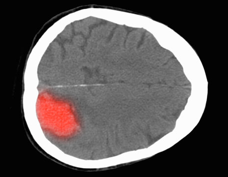 CT scan of the brain showing a stroke