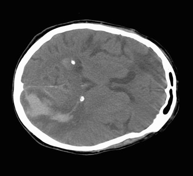 CT scan of the brain showing a stroke