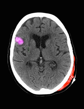 Contrecoup right frontal hemorrhagic contusion