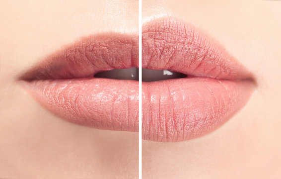 Female lips before and after augmentation procedure. Beauty concept