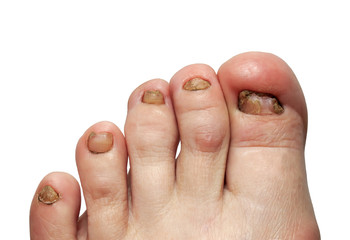 unhealthy toes with toenails affected by fungal disease